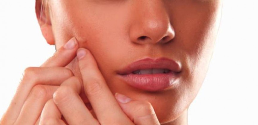 trattamenti acne blogimage