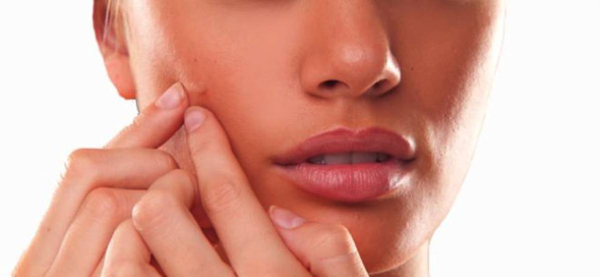 trattamenti acne blogimage